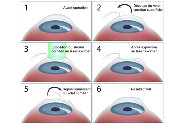 Techniques Lasik